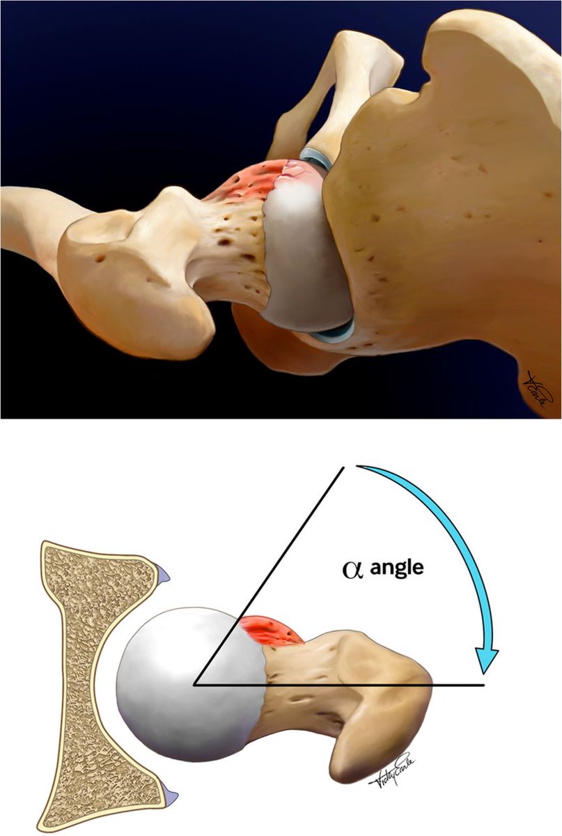 British Journal of Sports Medicine (BJSM) (@bjsm_bmj) on Twitter photo 🚨Oxford #ConsensusStatement on primary cam morphology and #FAI - part 1 from the YAHiR collaborative #AthletesHip
1️⃣ Defining attributes of cam
2️⃣ Use of "morphology"
3️⃣ Primary vs secondary cam
4️⃣ Imaging outcomes on MRI
<a href="/DrPaulDijkstra/">Paul Dijkstra</a> + team 👏
👉 bit.ly/3Pc1J3p 🚨Oxford #ConsensusStatement on primary cam morphology and #FAI - part 1 from the YAHiR collaborative #AthletesHip
1️⃣ Defining attributes of cam
2️⃣ Use of "morphology"
3️⃣ Primary vs secondary cam
4️⃣ Imaging outcomes on MRI
<a href="/DrPaulDijkstra/">Paul Dijkstra</a> + team 👏
👉 bit.ly/3Pc1J3p