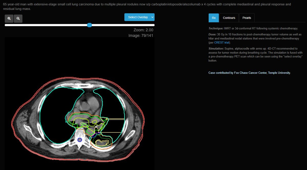 eContour (@econtourradonc) on Twitter photo Look 👀 at this awesome ✨ new case✨! Extensive-stage small cell lung carcinoma? ✅Sign us up!
Don't forget to select the PET/CT in the upper right hand corner to see the extent of disease!
Thanks 🙏🏽to Dr. Burbure & <a href="/JeremyPriceMD1/">JeremyPrice MDPhD</a> <a href="/FoxChaseCancer/">Fox Chase Cancer Center</a>! Look 👀 at this awesome ✨ new case✨! Extensive-stage small cell lung carcinoma? ✅Sign us up!
Don't forget to select the PET/CT in the upper right hand corner to see the extent of disease!
Thanks 🙏🏽to Dr. Burbure & <a href="/JeremyPriceMD1/">JeremyPrice MDPhD</a> <a href="/FoxChaseCancer/">Fox Chase Cancer Center</a>!
