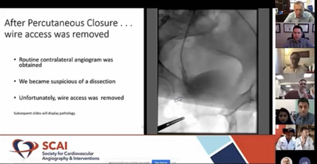 HadyLichaaMD's tweet image. @SCAI @ACCinTouch webinar on the management of #LargeBoreAccess #VascularComplications: #Perforation #Dissection #Bleeding

acc.org/Education-and-…

@DrDamluji @agtruesdell @Babar_Basir @w_jyg @AnkurKalraMD @EricSecemskyMD @DougDrachmanMD @prkothapalli #Cardiotwitter #ACCIC