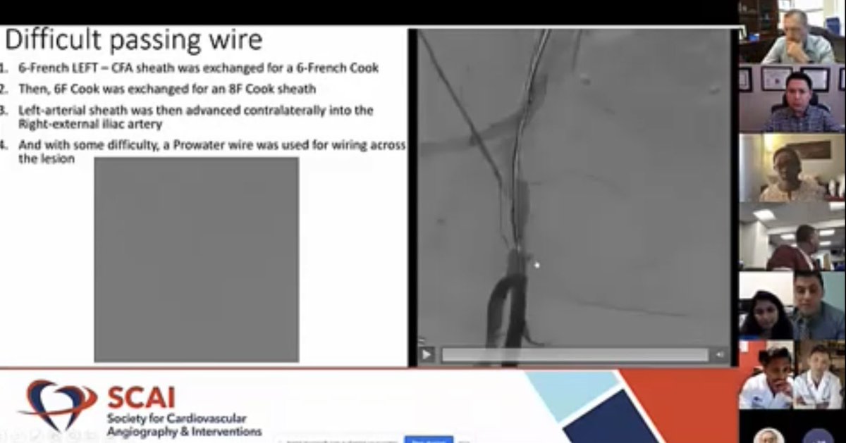 HadyLichaaMD's tweet image. @SCAI @ACCinTouch webinar on the management of #LargeBoreAccess #VascularComplications: #Perforation #Dissection #Bleeding

acc.org/Education-and-…

@DrDamluji @agtruesdell @Babar_Basir @w_jyg @AnkurKalraMD @EricSecemskyMD @DougDrachmanMD @prkothapalli #Cardiotwitter #ACCIC