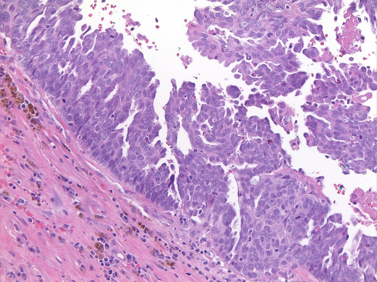 LLUHphysicians (@lluhphysicians) on Twitter photo Dr. <a href="/codyscarter/">Cody Carter, MD</a> & gynecological oncologist team have begun sending eligible tissue samples for FOLR1 testing to assess eligibility for promising, new FDA-approved targeted molecular therapy drug for those w/ refractory ovarian cancer like those shown in microscopic images ⬇️ Dr. <a href="/codyscarter/">Cody Carter, MD</a> & gynecological oncologist team have begun sending eligible tissue samples for FOLR1 testing to assess eligibility for promising, new FDA-approved targeted molecular therapy drug for those w/ refractory ovarian cancer like those shown in microscopic images ⬇️