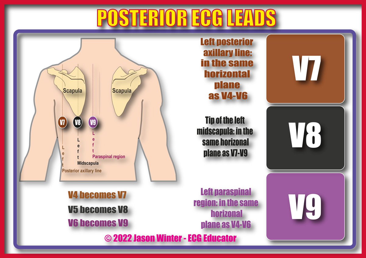 The ECG Educator 🩺 🫀 (@JasonWinterECG) on Twitter photo 2022-12-07 20:05:23