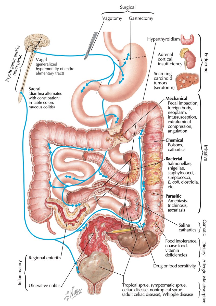 Causes of diarrhoea #4KMedEd (via Netter's)