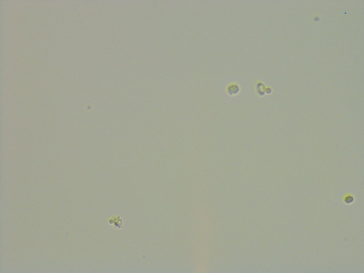 msc271's tweet photo. 44F w/Class IV LN, T1DM s/p DBD SPK 12/2019 c/b acute on chronic AMR despite excellent compliance, CKD IIIb of allograft kidney who presents to clinic for follow-up. #UrinarySediment #UrineMicroscopy #acanthocytes https://t.co/9Cp2AIiNQn