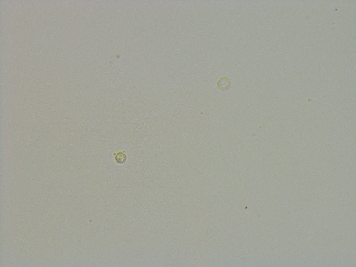 msc271's tweet photo. 64M with IgAN who presents to clinic for follow up. Spot UPCR down to 0.37g/g from 0.53g/g but uptrending Cr and a questionable WBC cast vs RTEC cast on #UrinarySediment exam. #UrineMicroscopy #acanthocytes https://t.co/I6RHCOJ060