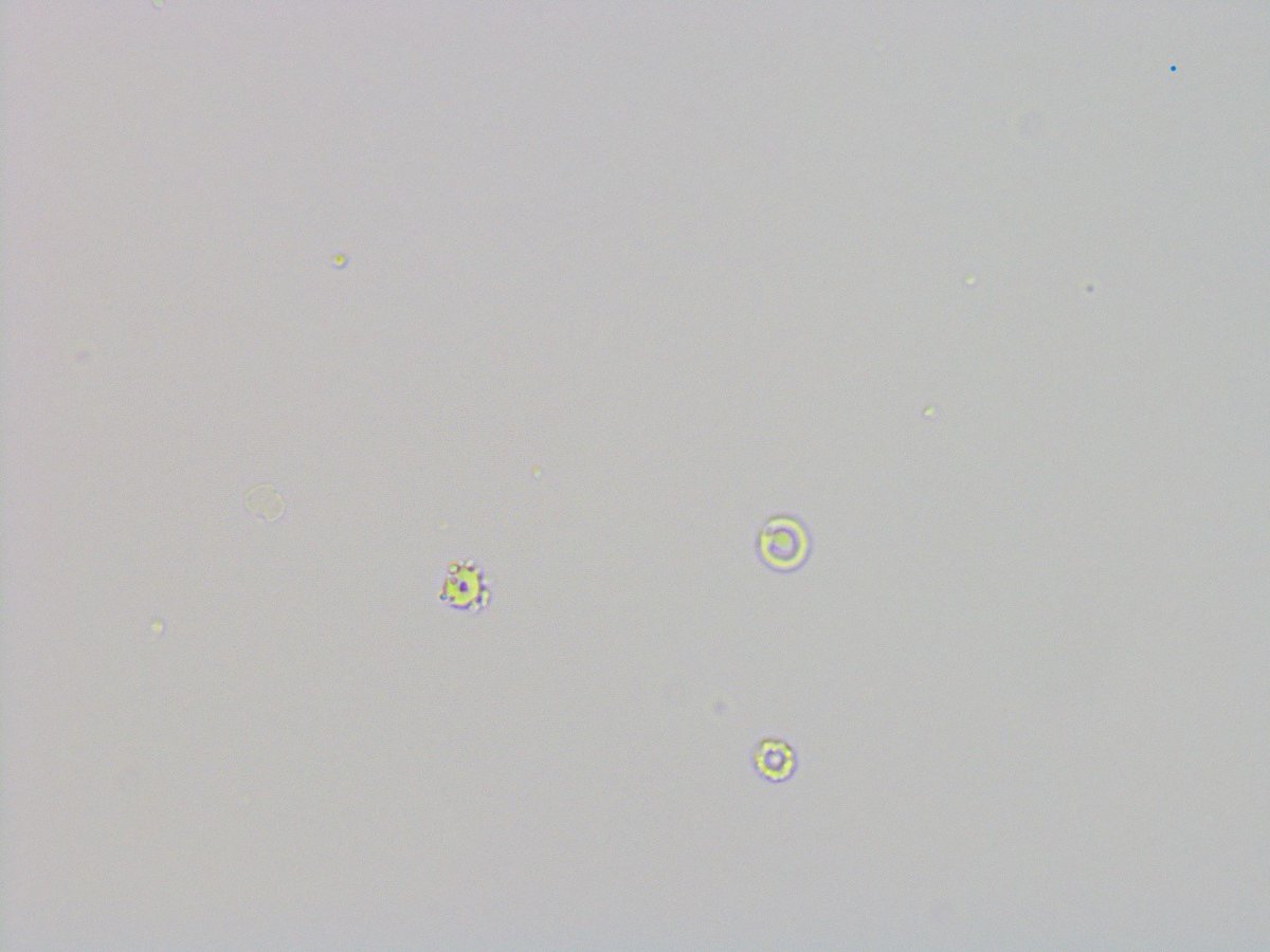 msc271's tweet photo. 64M with IgAN who presents to clinic for follow up. Spot UPCR down to 0.37g/g from 0.53g/g but uptrending Cr and a questionable WBC cast vs RTEC cast on #UrinarySediment exam. #UrineMicroscopy #acanthocytes https://t.co/I6RHCOJ060