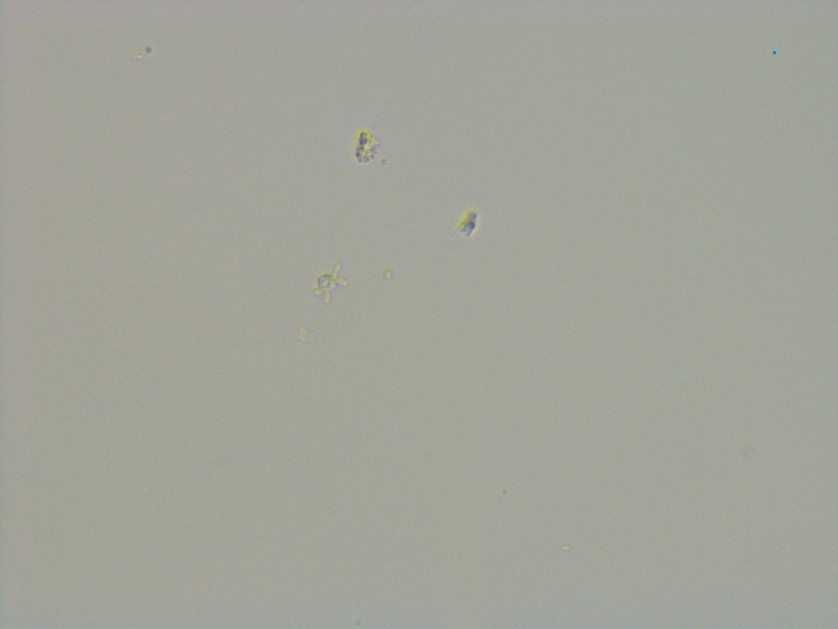 msc271's tweet photo. 64M with IgAN who presents to clinic for follow up. Spot UPCR down to 0.37g/g from 0.53g/g but uptrending Cr and a questionable WBC cast vs RTEC cast on #UrinarySediment exam. #UrineMicroscopy #acanthocytes https://t.co/I6RHCOJ060
