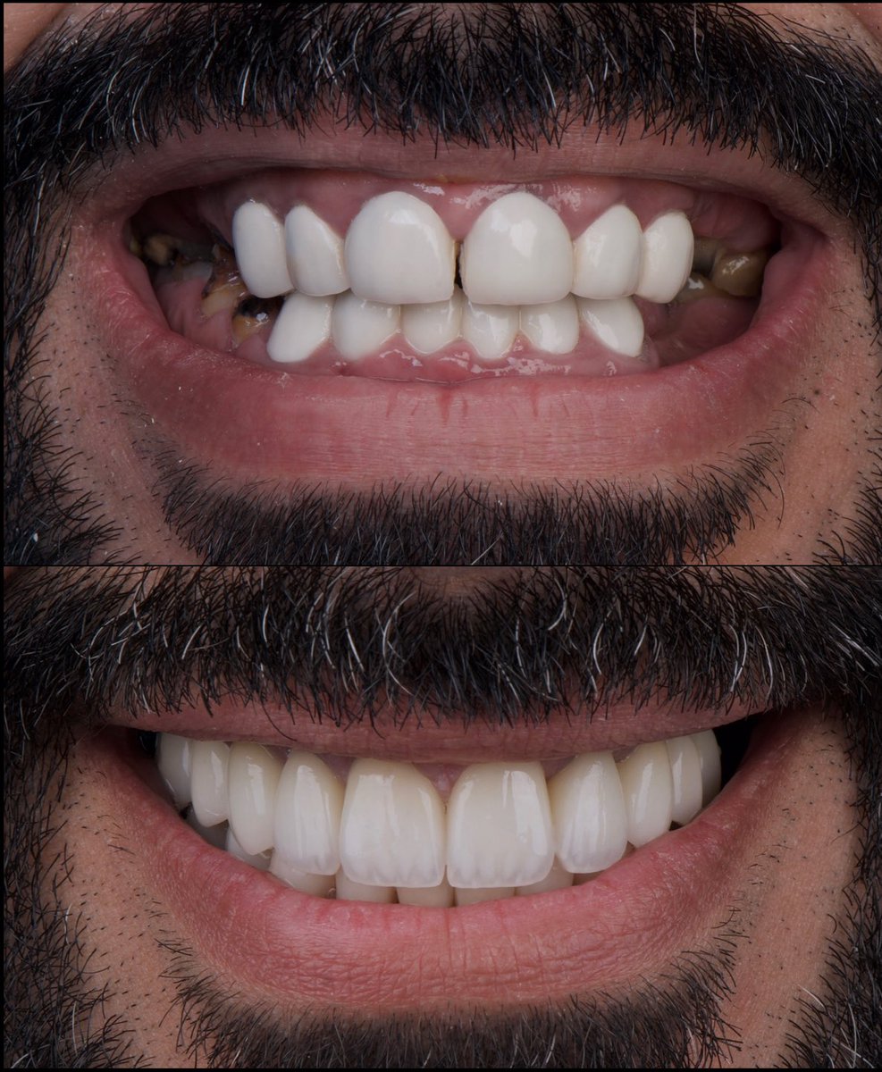 من الحالات التي تم المحافظة على الأسنان المتبقية بعد إصلاحها واستبدال المفقودة بزرعات الأسنان <a href="/dentalhousec/">Dental House Clinics</a>