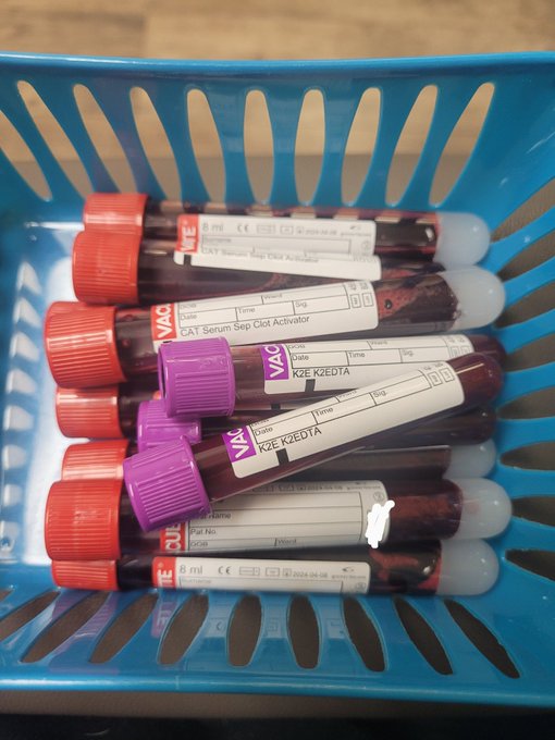 My personal record for most viles of blood at once. ELEVEN!😳  + no sleep last night (nap from 9a-11a<a href="/tag/powerexchange"class="tags"><span>#powerexchange</span></a><a href="/tag/instalive"class="tags"><span>#instalive</span></a>
