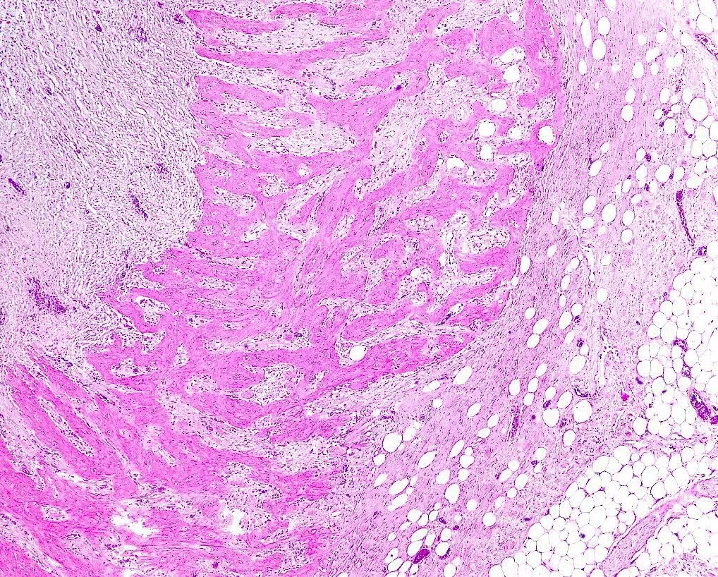 Sections from autopsy revealing bone formation in the mesentery in a patient who was status post multiple abdominal surgeries. What is this process called? kikoxp.com/posts/12785 #PathTwitter #MedTwitter