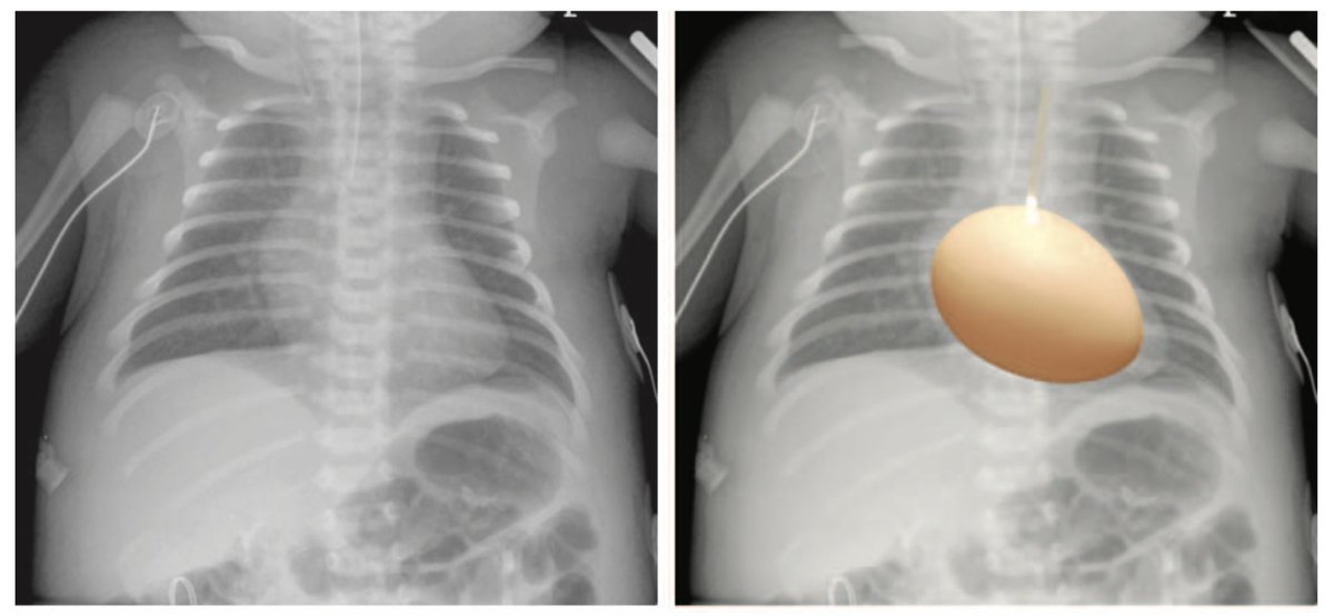 NephroP's tweet photo. Classic Chest #Xray Signs of Congenital Cardiovascular Abnormalities.
Interesting article 📖👇🏼
🔗 https://t.co/ysyc6nNkNb
#MedEd #radiology #criticalcare https://t.co/k6juCdPvR8