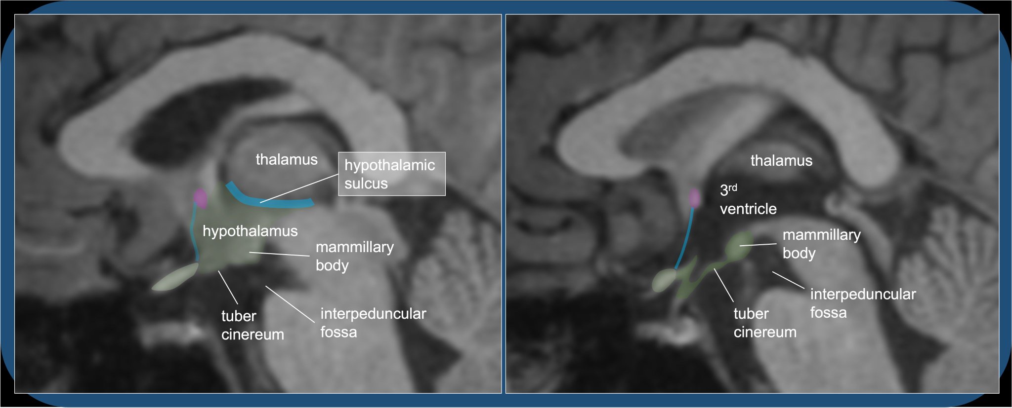 Hypothalamic Sulcus
