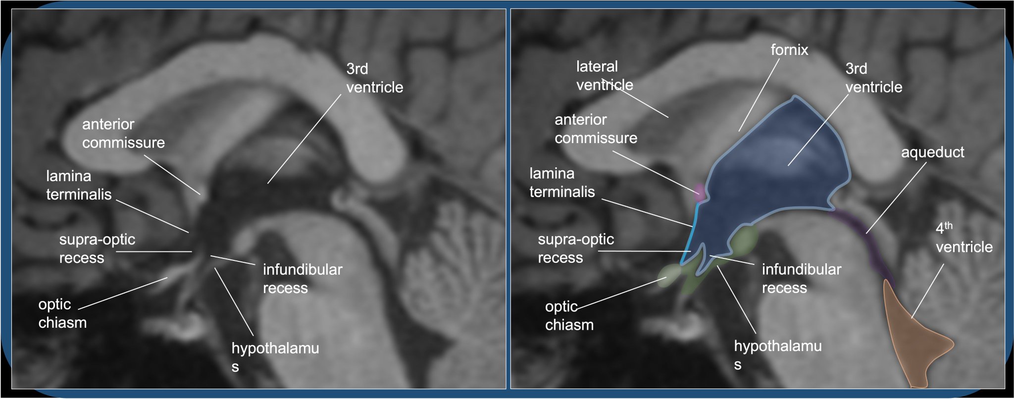 Aaron Rutman, MD on Twitter "Medially, the 3rd ventricle separates the