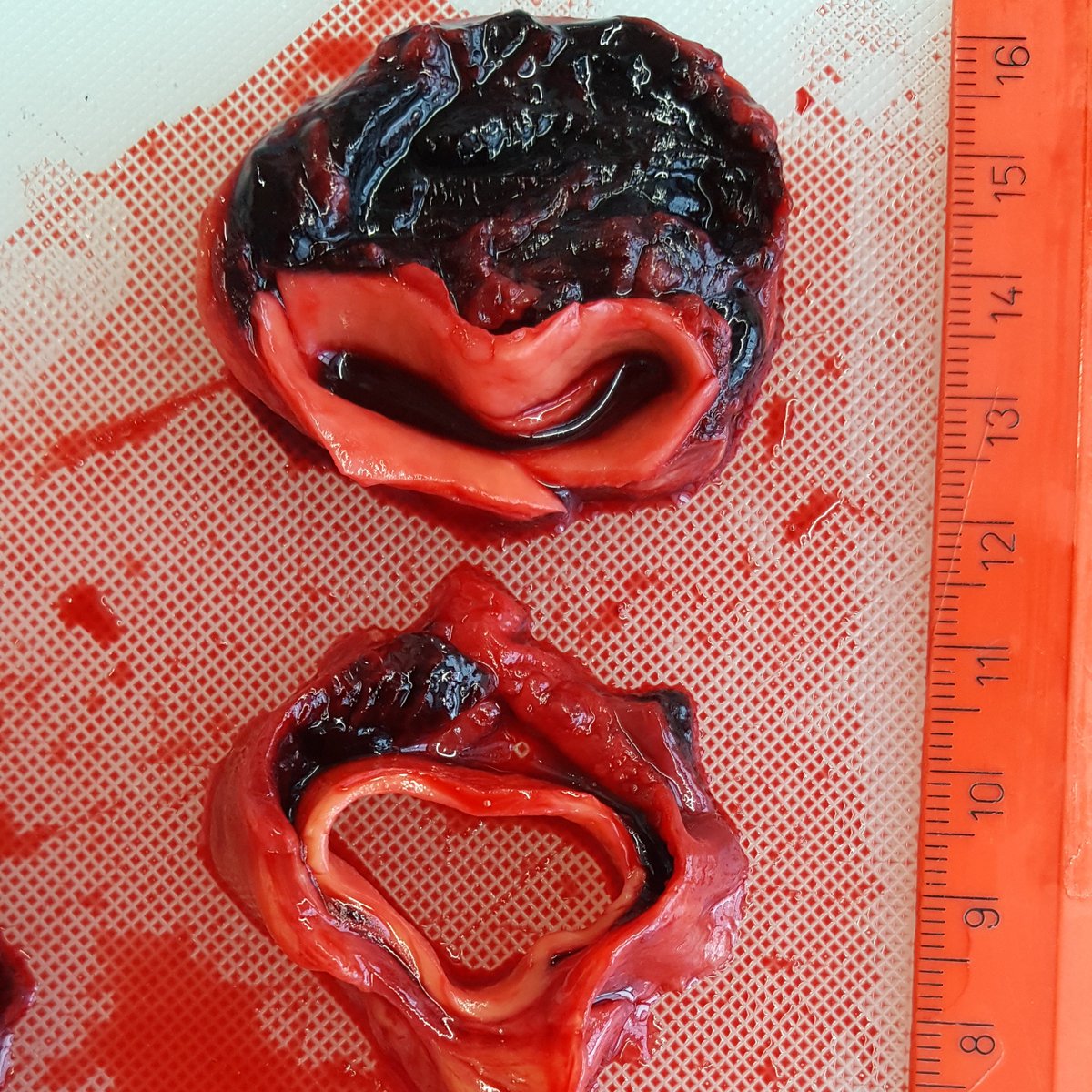This is what a fresh #aortic #dissection with thrombosed false lumen looks like. One is not surprised that the false lumen tends to expand subsequently. 
#aortaed #aorticsurgery #vascularsurgery #aorta