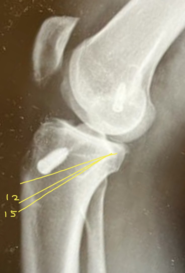 VolkerMusahl's tweet photo. @PhilippNiemeyer Great Q. Let’s say slope is 19 deg. Plan correct to 4 or 7 deg? Say overcorrect to 4 deg. Equals 15mm ACW. Short postop XR will show -1 deg neg slope. Big deal??? #reducetibia #protectacl 😉 💪 https://t.co/Ri9ASEqaPX