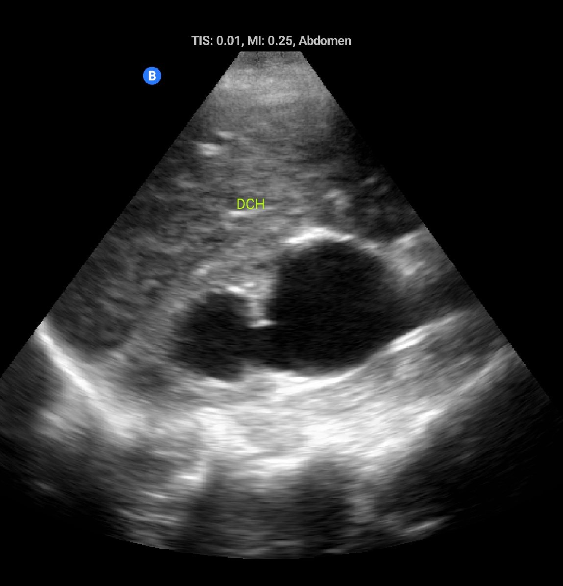MartinVargas89's tweet photo. Hombre de 65a derivado para hemodiálisis por anuria y daño renal agudo. Cabe destacar hidronefrosis y balon de sonda foley en segmento prostático. 😵😖
#POCUS #NephPocus https://t.co/6YCacY43pN