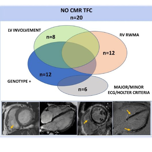 🚩Cardiorresonancia y miocardiopatía arritmogénica en deportistas: - 86% 🤵 con MAVD: CMR anormal - 46% no cumplían criterios TFC - En 🏃🏻‍♂️relación volumen telediastólico RV/LV > 1.2 y FEy ventrículo dcho ≤ 45%: 🚨 Fuertes predictores de patología! #CardiologiaDeportiva @nory_88