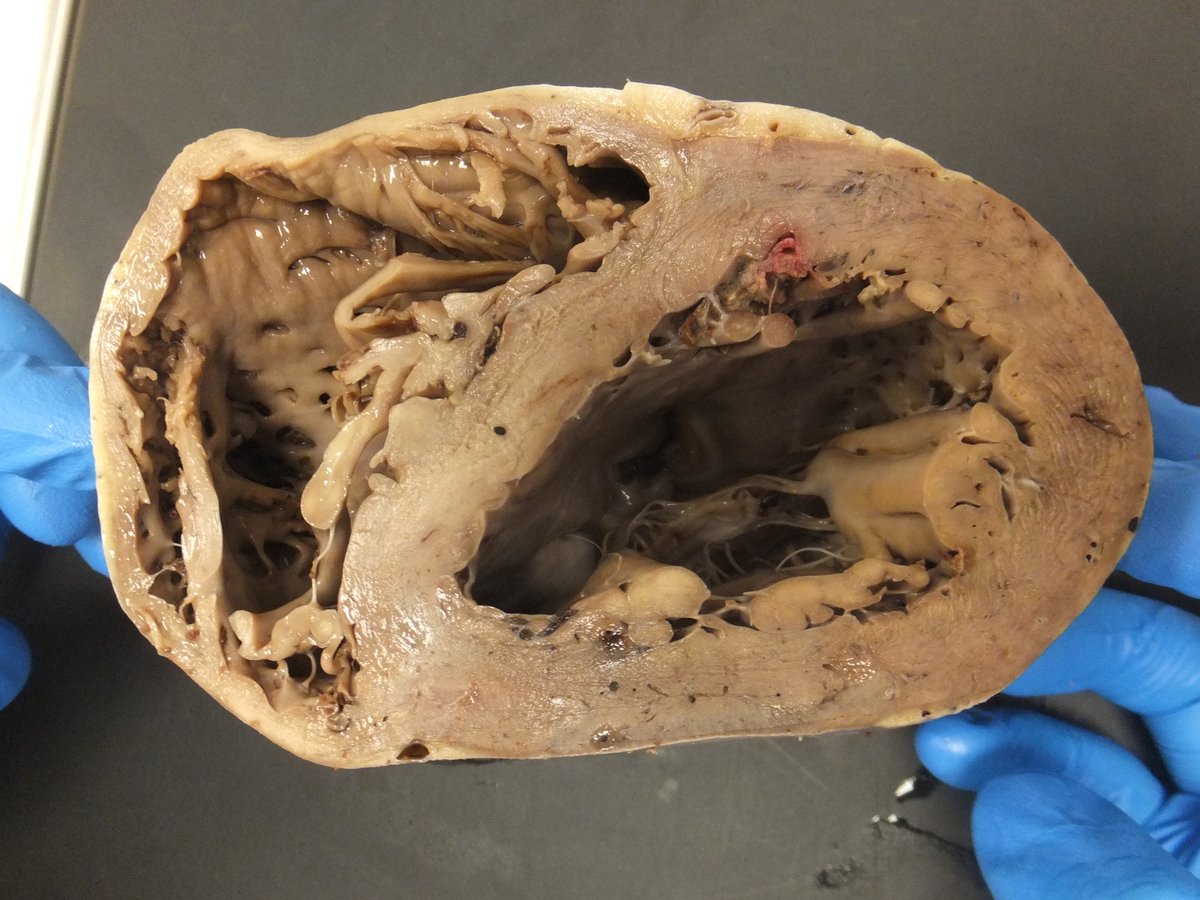 CRY Cardiac Path tweet media