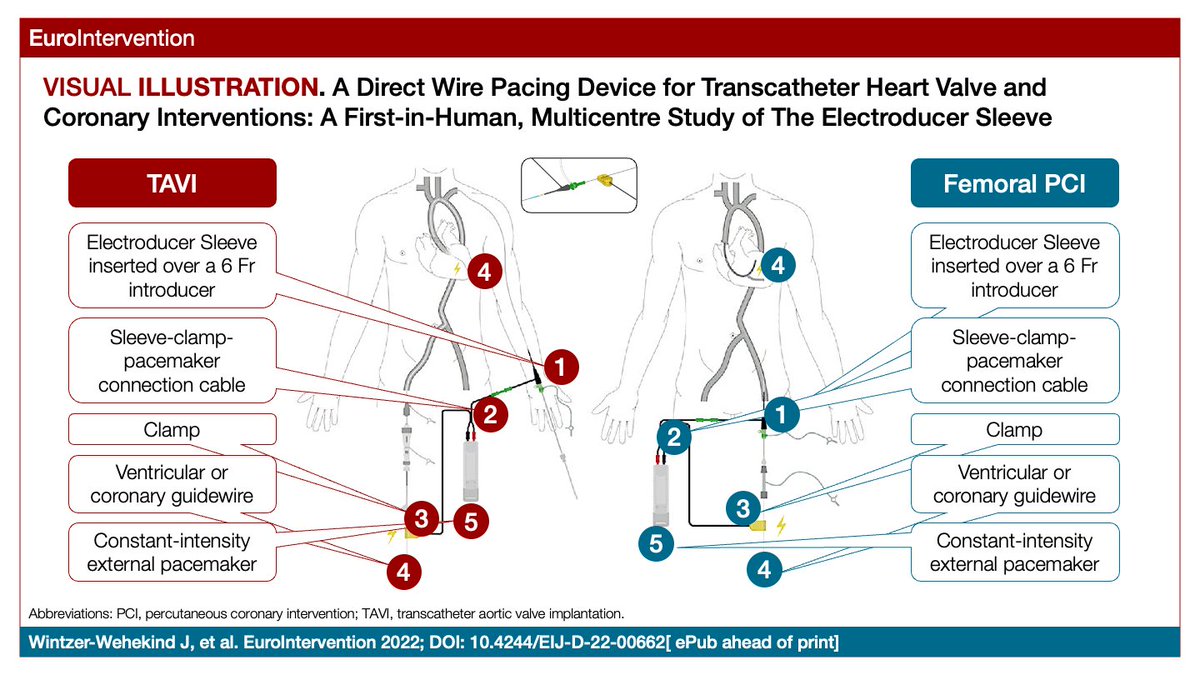 This is the first-in-human study of Electroducer Sleeve, a novel, purpose-built device designed to provide safe and effective unipolar pacing during percutaneous cardiovascular interventions (e.g., TAVI, PCI), with no need for a temporary venous pacemaker. eurointervention.pcronline.com/article/a-dire…