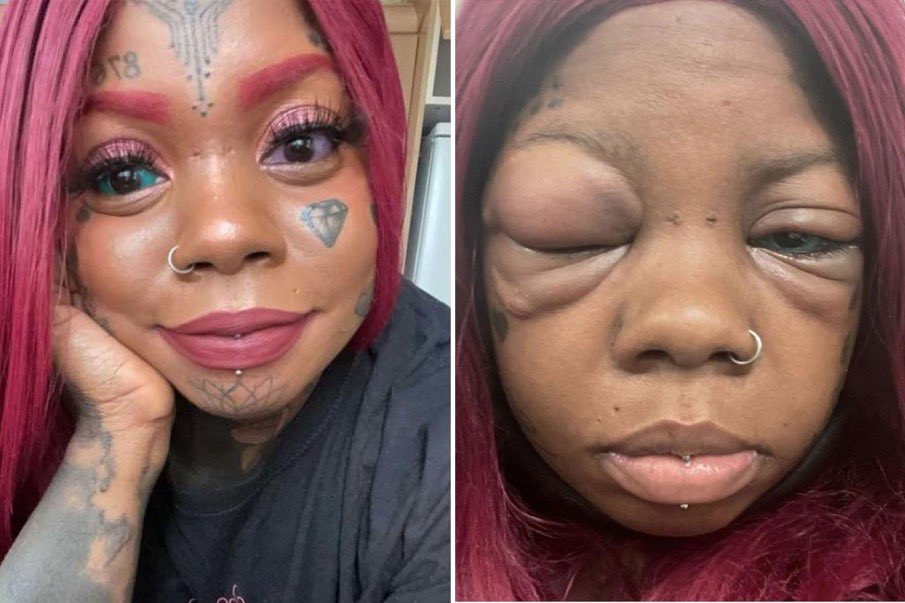 CerfiaFR's tweet photo. 🇬🇧FLASH | Une #Britannique est devenue #aveugle après avoir tatoué ses globes oculaires. Elle voulait imiter une influenceuse. https://t.co/aHqGX9onjR