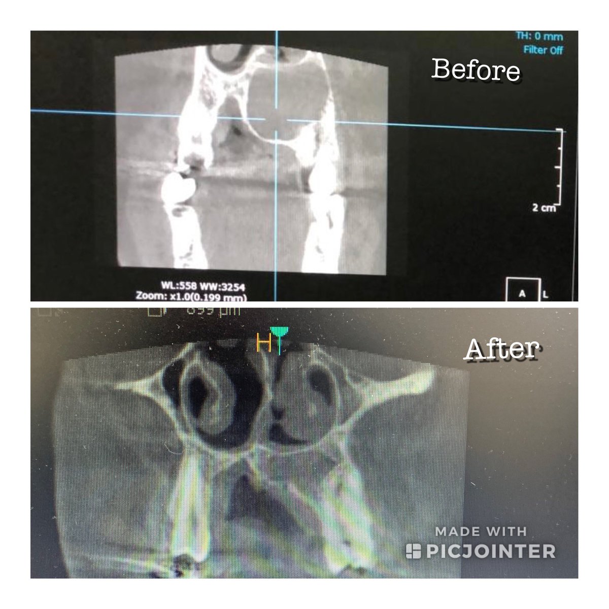 a_alqedrah's tweet photo. 2 yrs follow up of an old trauma to upper left central causing huge palatal swelling and severe bone resorption reaching hard palate treated ONLY with Nonsurgical RCT and showing complete healing… #Endo power👌. https://t.co/Y4AZrSwBLP