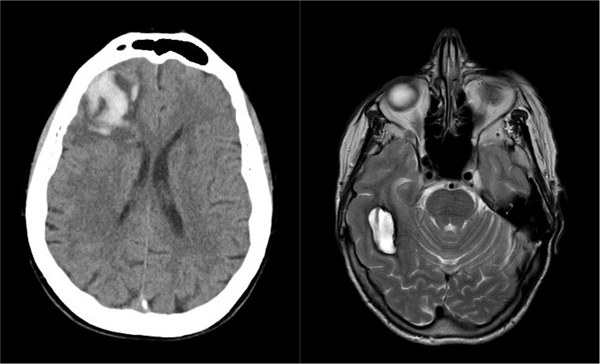 giampieroviz's tweet photo. 81 y-o woman with AF and contraindication to OAC (2 ICHs under NOAC and LMWH). TEE showed organised thrombus in LAA, apparently contraindicating LAAC.
After positioning #TriGUARD #cerebralprotection, #LAAC was safely performed by pushing a 31mm #WatchmanFLX device.
#cardiotwitter https://t.co/XGnDn8P2rd
