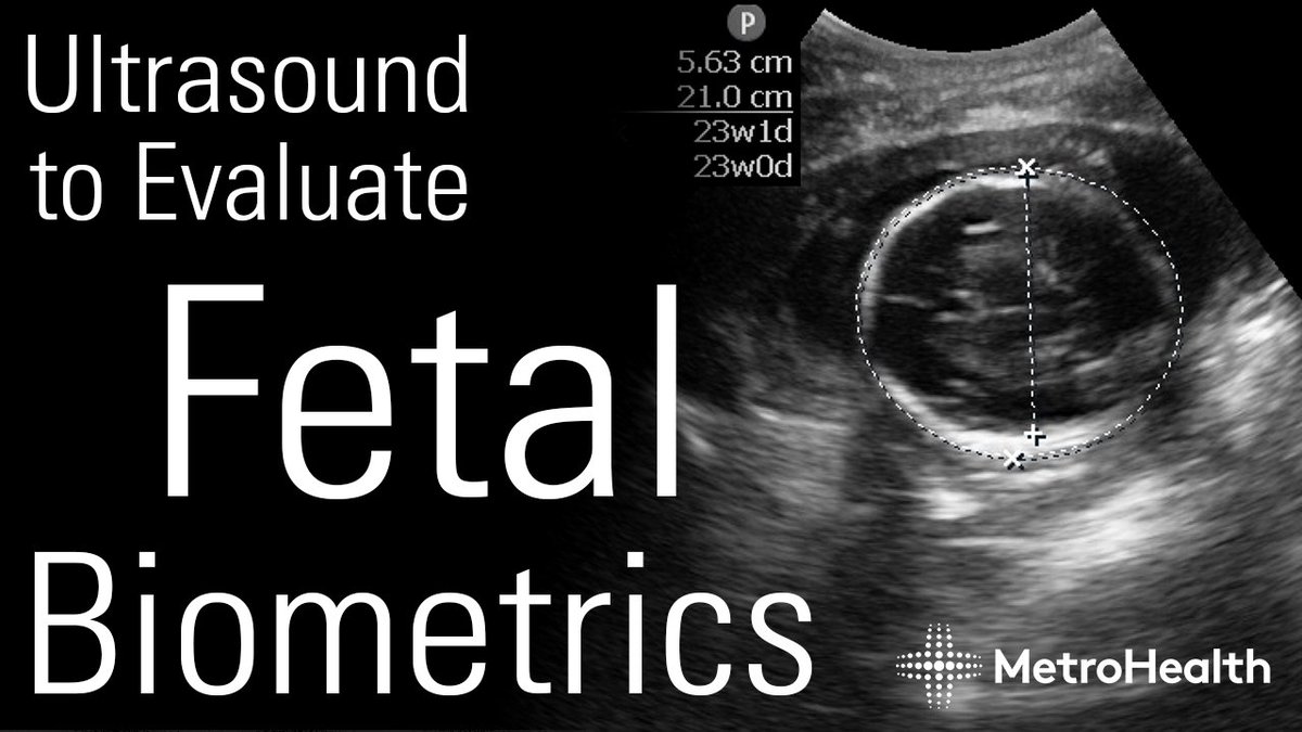And check out the video from last week's Grand Rounds.  Ultrasound to Evaluate Fetal Biometrics by @mtabbut.

youtu.be/Ud5fPuq4Twk

#MetroEUS #POCUS #Ultrasound #MedTwitter #OBGYN #EmergencyMedicine