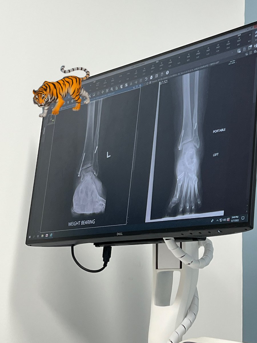 bunnnytiger's tweet image. I go back in 2 weeks December 20th (as long as it doesn’t snow) not traveling in snow #hardwareremoval #anklehardwareremoval 
One step at a time! 💫