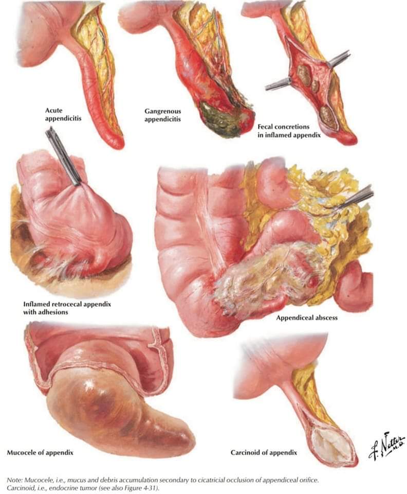 DRAFTABAHMED7's tweet photo. A beautiful presentation &amp; complications of Acute appendicitis.
𝗥𝗲𝗳:Netter’s Illustrated 
Human Pathology, 2nd ed. https://t.co/rnVz2ixg8X