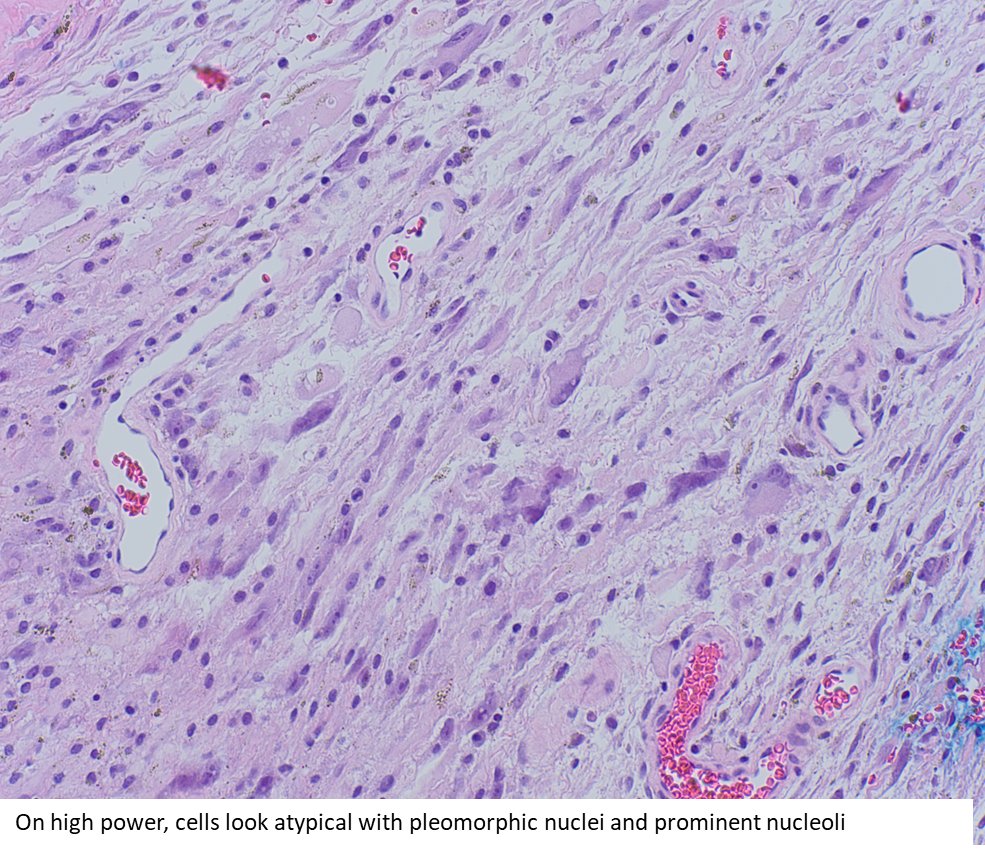 Annie Garcia (@anniegarciamd) on Twitter photo "Fat" sometimes means "Pleomorphic hyalinizing Angiectatic Tumour of soft parts" or PHAT, a rare soft tissue lesion that most often involves subcutaneous tissue of lower extremities. I included the classic histologic features in these 4 pics. #BSTPath #PathTwitter <a href="/uwlabmedpath/">UW Dept. of Laboratory Medicine and Pathology 🔬</a> "Fat" sometimes means "Pleomorphic hyalinizing Angiectatic Tumour of soft parts" or PHAT, a rare soft tissue lesion that most often involves subcutaneous tissue of lower extremities. I included the classic histologic features in these 4 pics. #BSTPath #PathTwitter <a href="/uwlabmedpath/">UW Dept. of Laboratory Medicine and Pathology 🔬</a>