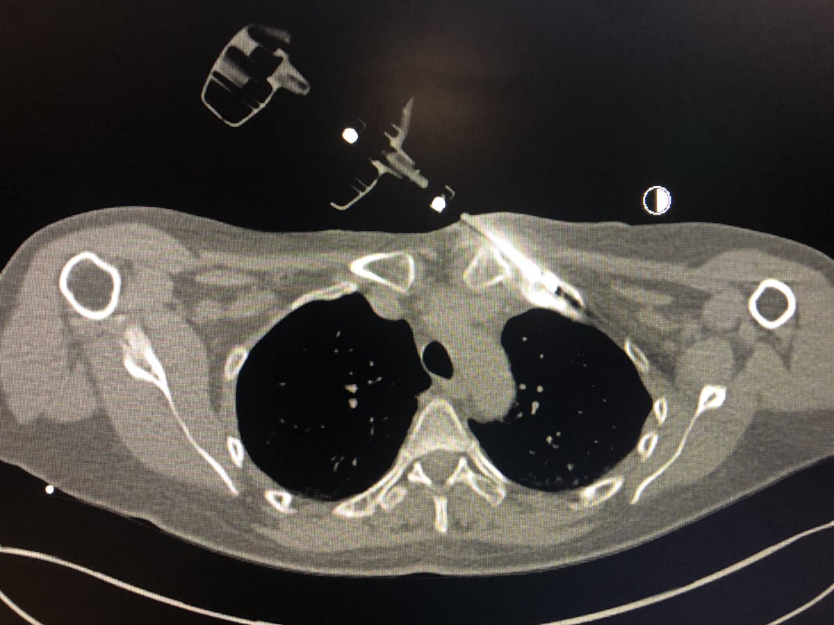 Can’t say that medial first ribs are my favorite thing to do…😬
