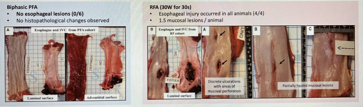 Clinton Thurber MD (@epentraining) on Twitter photo Striking differences between RF and PFA in esophageal injury in animal models #EPeeps <a href="/aalahmadmd/">Amin Al-Ahmad, MD</a> <a href="/KTamirisaMD/">Kamala Tamirisa MD</a> <a href="/MehakDhande/">Mehak Dhande, MD (she/her)</a> <a href="/PrashSanders/">Prash Sanders</a> <a href="/natale_md/">Andrea Natale MD</a> Striking differences between RF and PFA in esophageal injury in animal models #EPeeps <a href="/aalahmadmd/">Amin Al-Ahmad, MD</a> <a href="/KTamirisaMD/">Kamala Tamirisa MD</a> <a href="/MehakDhande/">Mehak Dhande, MD (she/her)</a> <a href="/PrashSanders/">Prash Sanders</a> <a href="/natale_md/">Andrea Natale MD</a>