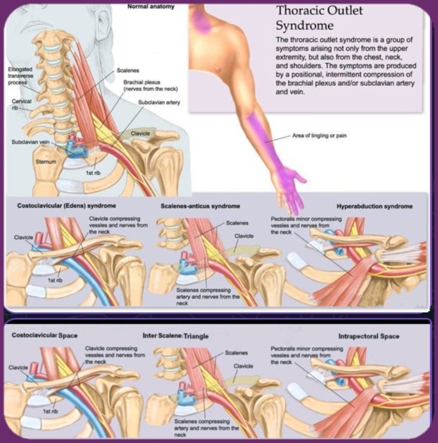 Dr. OMID BANDARCHI on X: 🛑Thoracic Outlet Syndrome(TOS). Signs&symptoms  arise from compression of Neuro-Vascular bundle by structures within 👉3  confined space of thoracic outlet(scalene triangle,costoclavicular space  pectoralis minor space). https