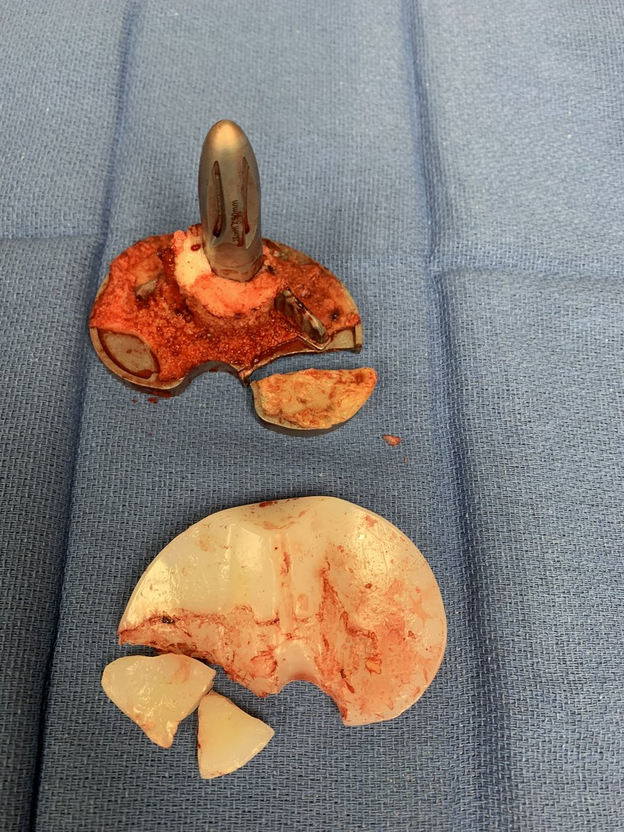 DrPhilHuang's tweet photo. @ArthroToday @EmanuelHaug @ArthroplastyB Not just the press fit version, but cemented too…. https://t.co/glgWx3UV37
