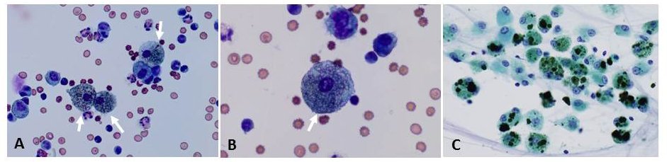 Prrmojeditor's tweet photo. Rapid Diagnosis of Hemosiderin-Laden Macrophages With...By Takeshi Saraya[ISSN 2377-1658]
Read the full article here: https://t.co/VdZ8OWIoix

For manuscript submission click here: https://t.co/qfO8JxGKhB

#openventio #openacess #openjournal #peerreviewed #pulmonary #respiratory https://t.co/dQ0ypVOHwN