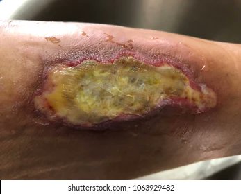 WSyazli's tweet photo. Have you or your family members / friends have a wound and noted the wound to be yellowish.

And you wonder are they infection with pus?

Do you know there are another condition known as slough, which does not require antibiotics!

Jom learn about it https://t.co/eETrwXMM9f