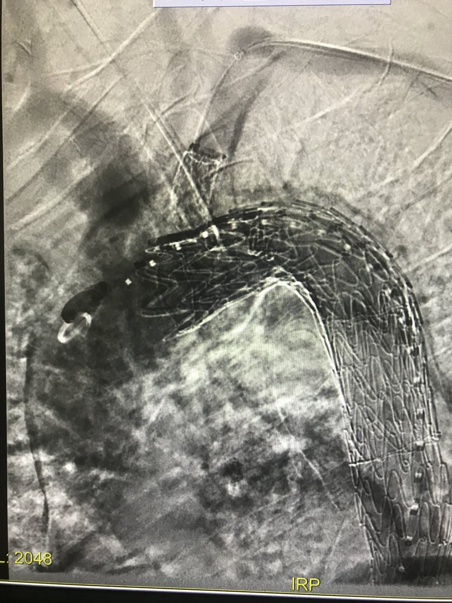 cfbechara's tweet photo. Haven’t posted in a while, busy fixing all sorts of aneurysms/dissections. want to recognize our great team, works so hard to achieve the best results,TBE total percutaneous in 55 mins, 90 min 4V FEVAR, @LoyolaSurgery @msoultmd @PeggyJoDowd1 @JonathanLinMD #gore #cook @HinesVAH https://t.co/4SOgfaknAs