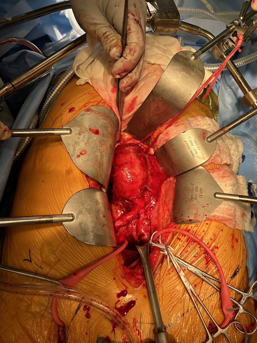 cfbechara's tweet photo. Haven’t posted in a while, busy fixing all sorts of aneurysms/dissections. want to recognize our great team, works so hard to achieve the best results,TBE total percutaneous in 55 mins, 90 min 4V FEVAR, @LoyolaSurgery @msoultmd @PeggyJoDowd1 @JonathanLinMD #gore #cook @HinesVAH https://t.co/4SOgfaknAs