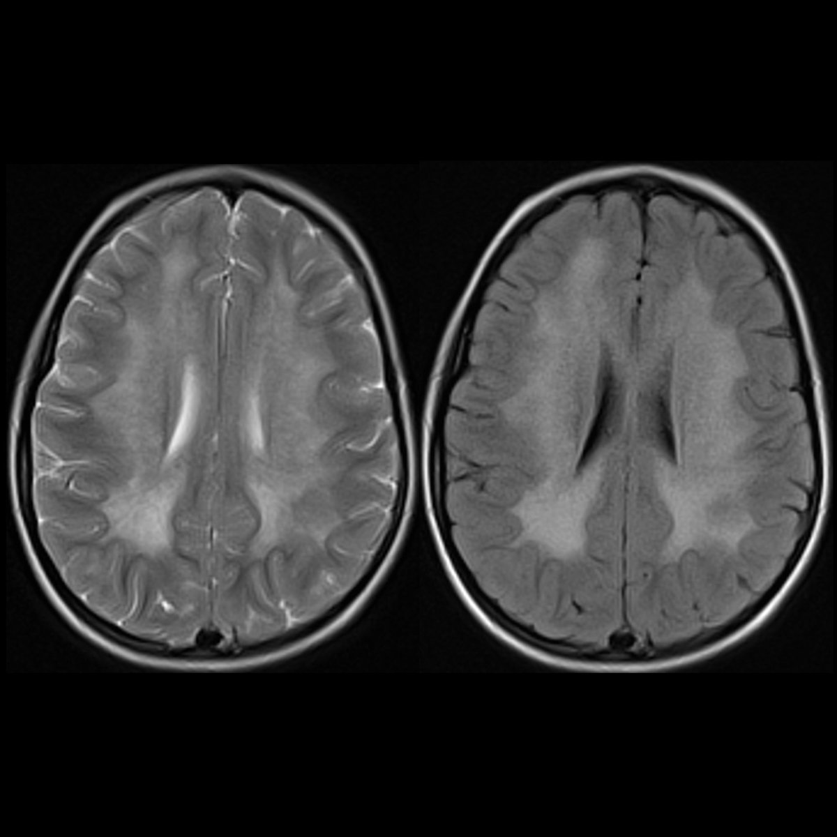 T2(left)+FLAIR(right) MRI show bilateral symmetrical confluent increased signal throughout white matter in a butterfly pattern.

Ddx. Preschooler with gait disturbance.
What is your diagnosis?