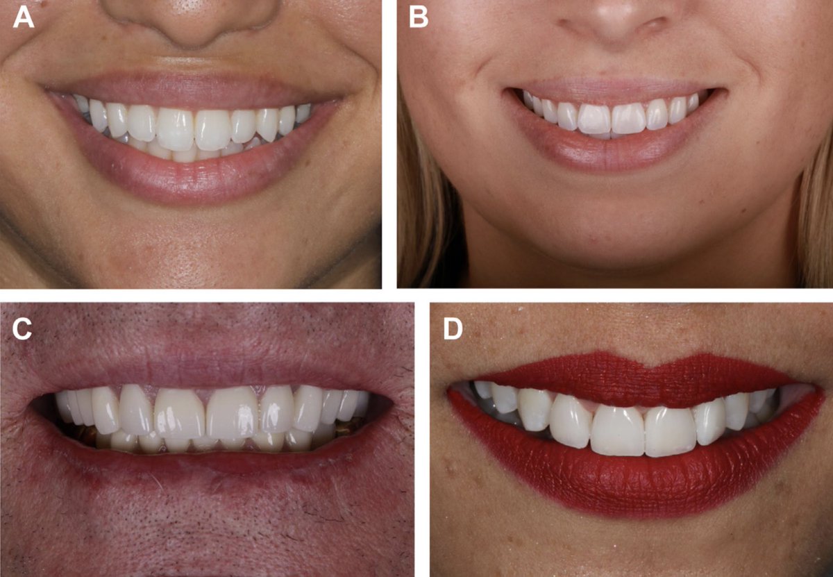 Fundamentals of smile design:
1- Dr Roblee: interdisciplinary dentofacial therapy (IDT) model
2-Dr Frank Spear and John Kois :facially generated treatment planning (FGTP) model
3- Robbins and Rouse: Global Diagnosis (GD)model that focuses on the “gummy smile” 
طرق تصميم الابتسامه