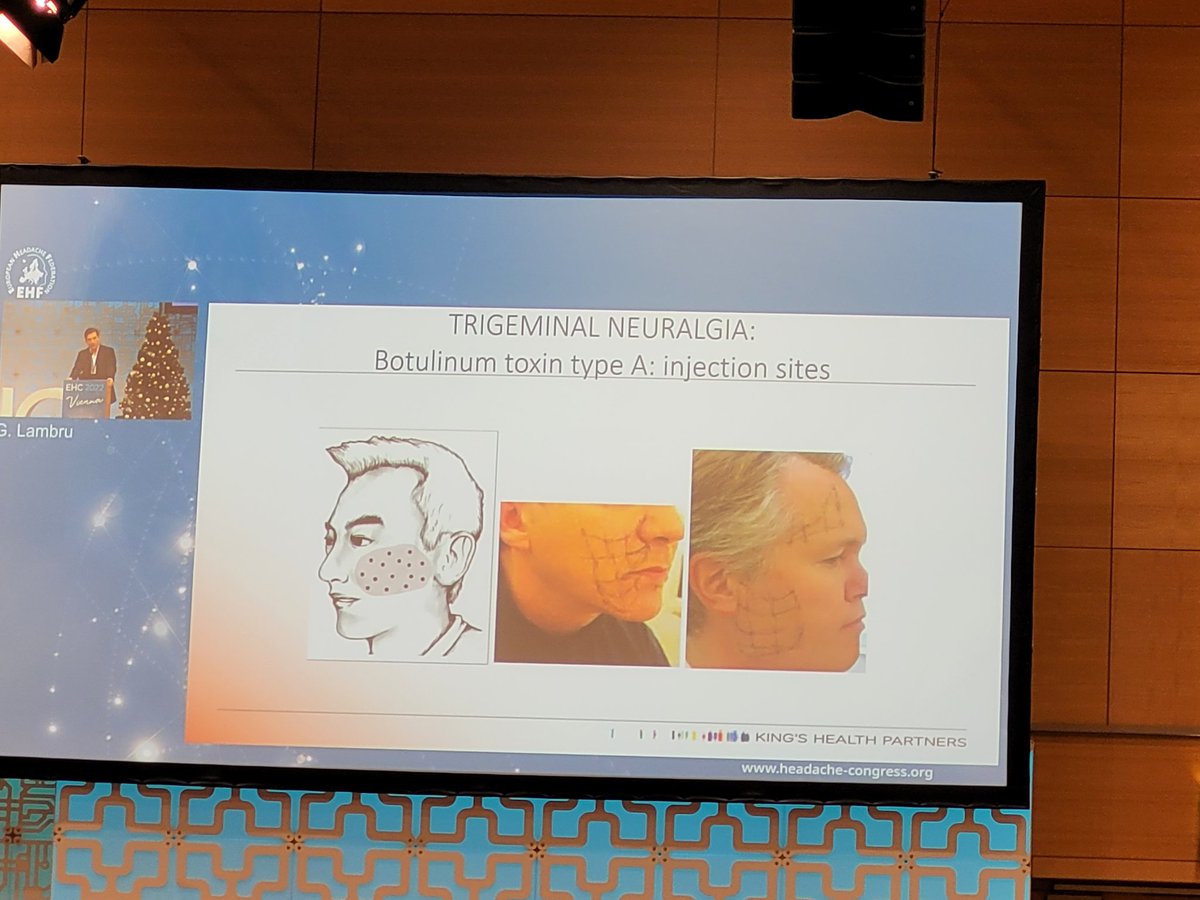 ap_andreou's tweet image. #Botox- an effective treatment in #TrigeminalNeuralgia but use of small dose due to facial paralysis limits its efficacy. Hence why we need the non-paralytic #bitox to achieve maximum efficacy! 10.1007/s13311-020-00967-7 @GSTT_Headache @g_lambru @MedResFdn @WolfsonCARD #EHC2022