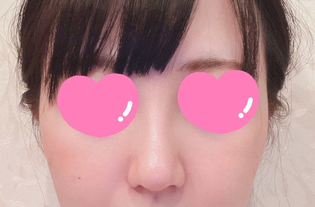 a0x_j's tweet photo. @gamipsjapan  ガミ整形外科　GAMI整形外科　　鼻フルレポ　3ヶ月

最初は腫れもあったので、整形？と聞かれることもありましたが、最近は言われることもなく腫れなども感じずかなり顔に馴染んできてるなって感じがします。
大きく笑ったり口元を大きく動かした時に先端はまだ違和感があります。 https://t.co/kU9lDPWE4m