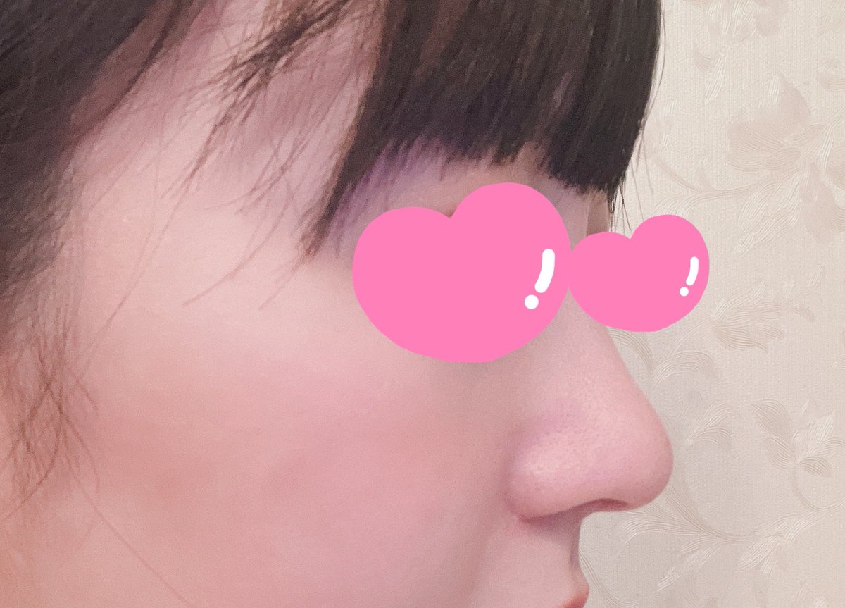 a0x_j's tweet photo. @gamipsjapan  ガミ整形外科　GAMI整形外科　　鼻フルレポ　3ヶ月

最初は腫れもあったので、整形？と聞かれることもありましたが、最近は言われることもなく腫れなども感じずかなり顔に馴染んできてるなって感じがします。
大きく笑ったり口元を大きく動かした時に先端はまだ違和感があります。 https://t.co/kU9lDPWE4m