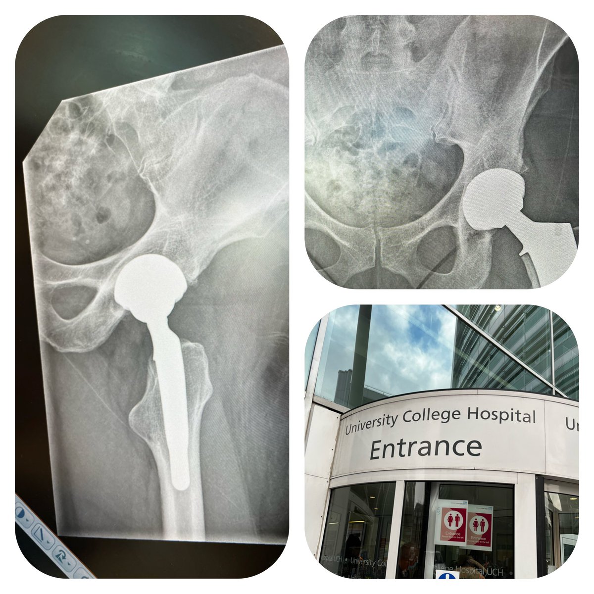 Thanks UCLH &amp; Mr Hutt, all good 8 weeks post op! 👍🏻
