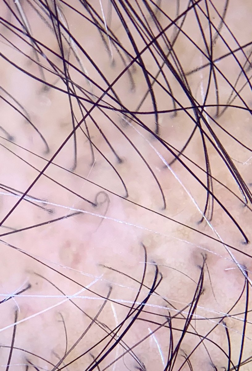 DonovanMedical's tweet photo. Trichoscopy of androgenetic alopecia,
2 important trichoscopic features : 1) conversion of thick terminal hairs into thinner &amp; shorter hairs known as “miniaturized” and “vellus” hairs and 2) conversion of bundles of 1-3 hairs into openings just having a single hair or no hair. https://t.co/0tkMoL3ARS