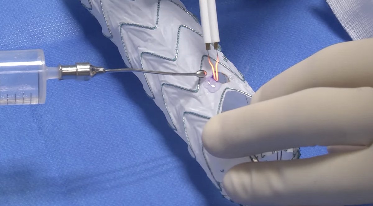 Vascupedia_com's tweet photo. #Tipfortheweekend @ #Vascupedia
Double homemade fenestrated stent graft for total endovascular aortic arch repair. L. Canaud 🇫🇷
One of the most viewed posts in 2022 👏
👉https://t.co/JiYf53qTGE
@AortaSurg @AortophilicMD @DrAliAzizzadeh @FotehMazinMD @_backtable
#AortaED #MedEd https://t.co/552caHHedh