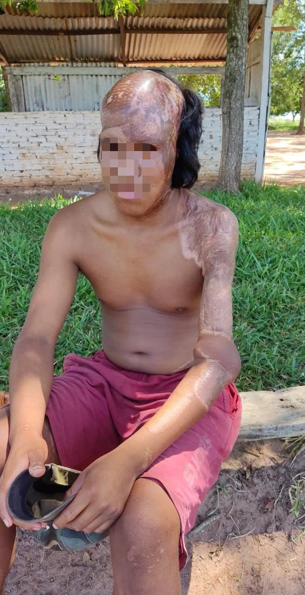 adri_navas's tweet photo. Él es Ariel (con el permiso para subir su foto) hace unos meses tuvo un accidente en la moto, mientras manejaba cruzó un charco de agua y no vio que un cable estaba suelto, recibió una descarga y … 

🧵 https://t.co/aQArWaSR1K