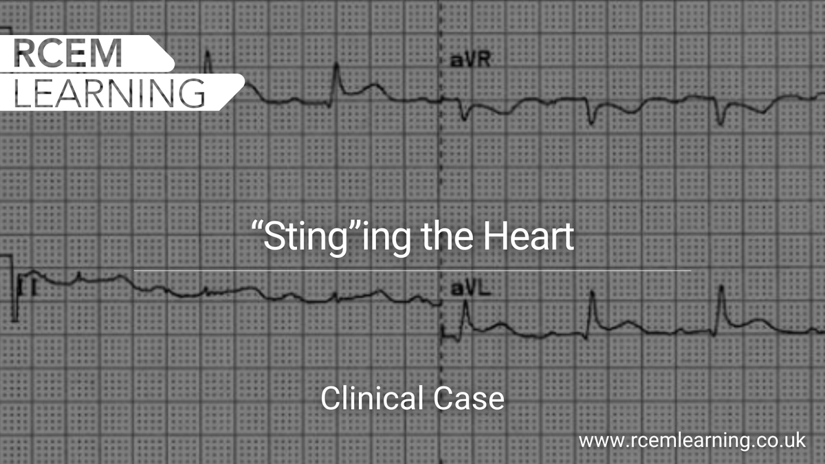 NEW: A patient with a bee sting complains of chest pain and has ECG changes, what are you thinking?

<a href="/drwill05/">William Wilson</a> 

Check out our #ClinicalCase 🆓here: rcemlearning.co.uk/modules/stingi…