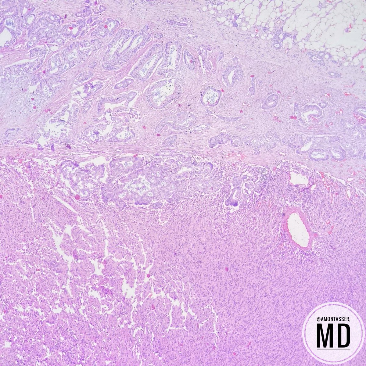 AMontasserMD's tweet image. Surgeon: it looks like GIST but the endoscopic biopsy report says adenocarcinoma!
Me: well.. I’ve got news 😅
#pathology #surprise #GIpath #PathTwitter #collision #Tumor