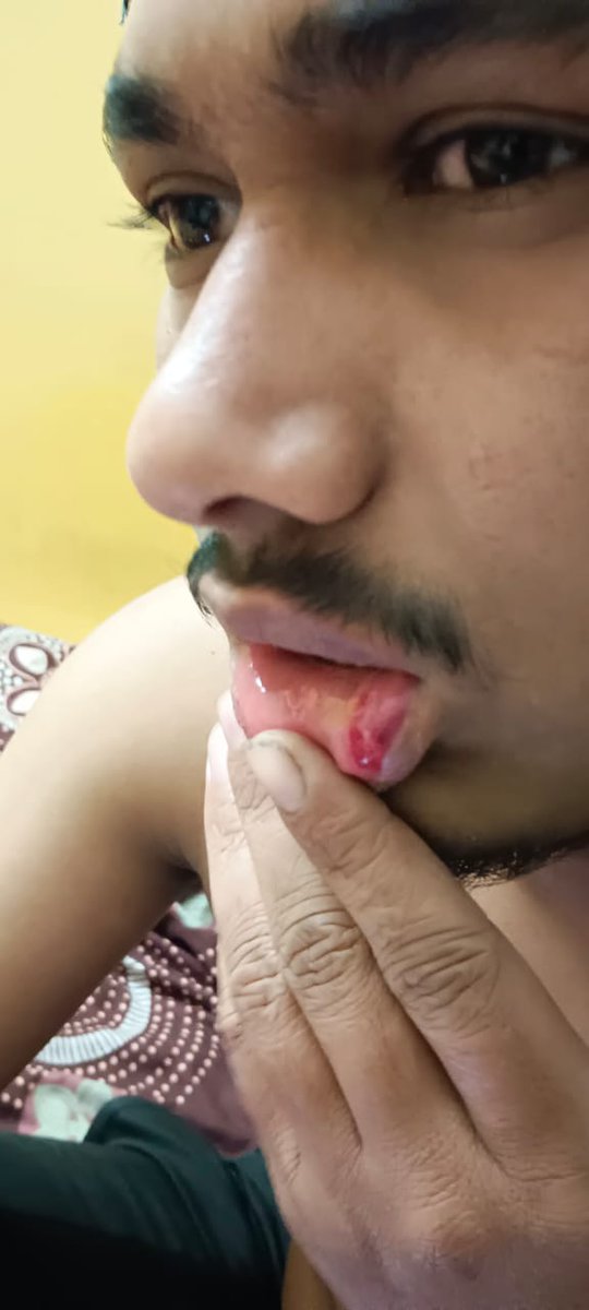 pavand028's tweet photo. ಕುಂದನಹಳ್ಳಿ ಗೇಟ್ HAL ಸಮೀಪ ಬೇಕರಿಯಲ್ಲಿ ನಿನ್ನೆ ನಡೆದ ಘಟನೆ ಪುಡಿ ರೌಡಿಗಳಿಂದ  ಅಮಾಯಕ ಬೈಂದೂರು ಹುಡುಗರ ಮೇಲೆ ಮಾರಣಾಂತಿಕ ಹಲ್ಲೆ  ಇಂತಹ ಘಟನೆಗಳು  ಬೆಂಗಳೂರಿನ ಪೊಲೀಸ್ ಕಮಿಷನರ್ ಇದರ ಬಗ್ಗೆ ಗಮನ ಹರಿಸಬೇಕು ಹಲ್ಲೆ ಮಾಡಿದವರಿಗೆ ಸರಿಯಾದ ಶಿಕ್ಷೆ ನೀಡಬೇಕಾಗಿ ವಿನಂತಿ @CPBlr @BlrCityPolice
@halairportps @JnanendraAraga https://t.co/ZL9jplzCF7